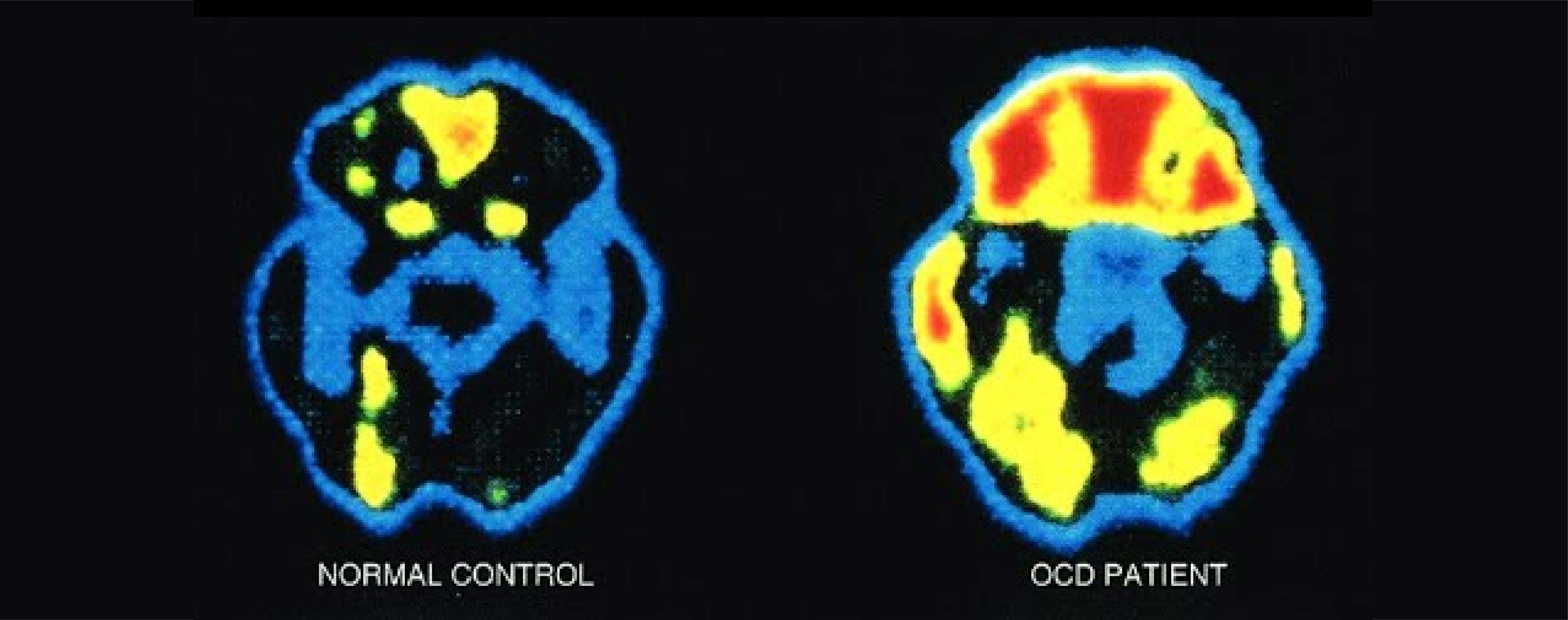 Ocd Brain Ocd When The Brain Misfires Danger Cues Cherry Hill Ocd Brain Ocd When The Brain Misfires Danger Cues Cherry Hill