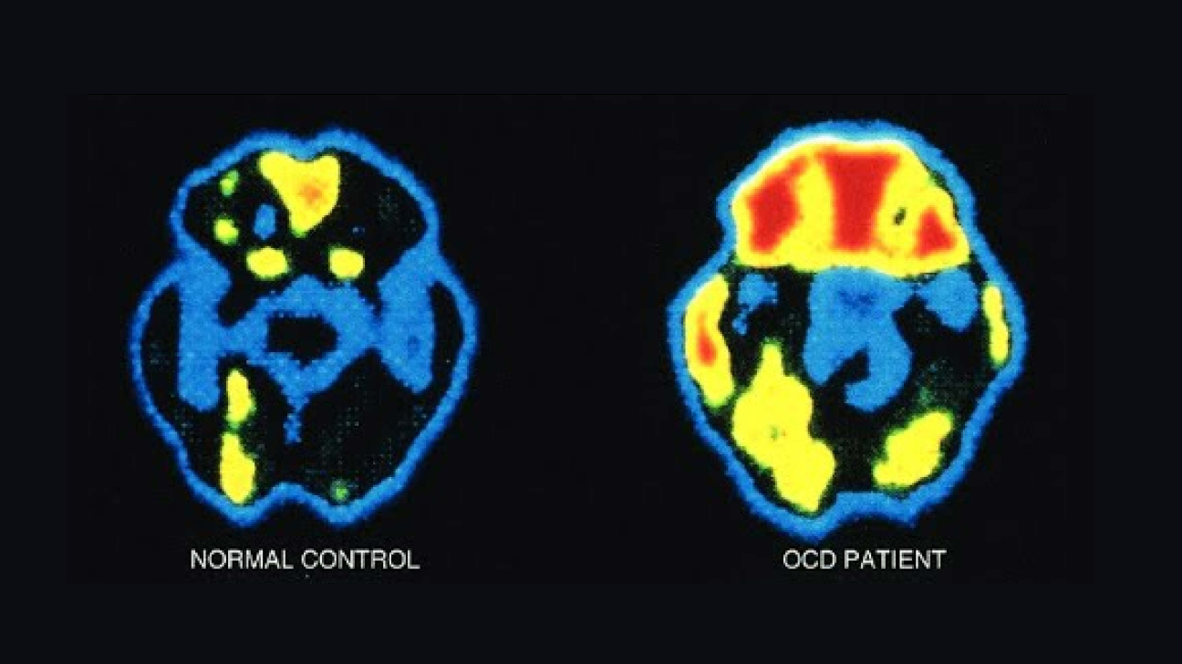OCDBrainvsNormalBrain3.png